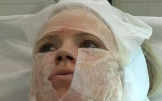 Девушка сделала несколько сотен порезов на лице ради красоты -ВИДЕО