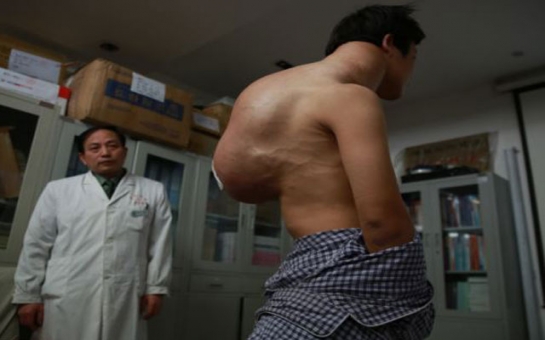 Врачи избавили китайца от 10-килограммовой опухоли