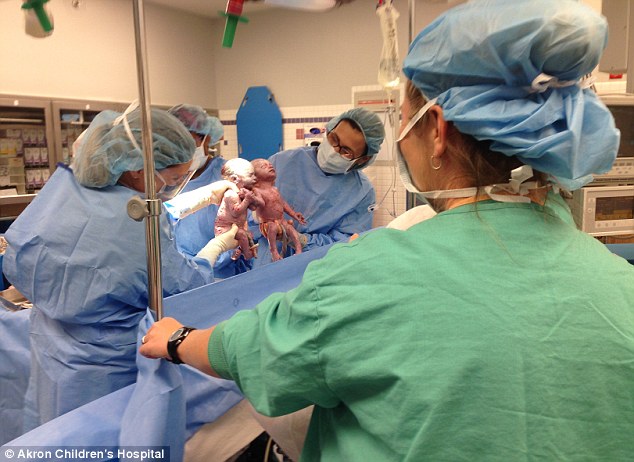 Rare 'mono mono' identical twin girls born HOLDING HANDS - PHOTO