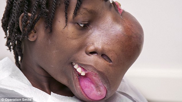 Haitian teen has FOUR-POUND tumor removed from her face - PHOTO