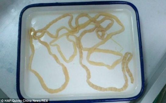 Chinese woman has EIGHT FOOT long tapeworm removed