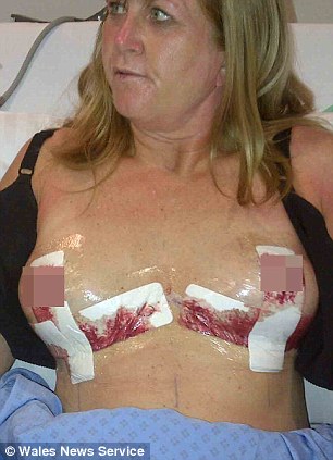 'My breast implant exploded inside me' - PHOTO