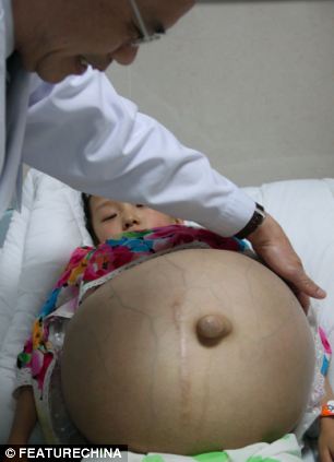 Girl has a watermelon-sized tumour removed from her ovaries - PHOTO