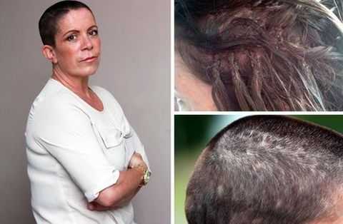 Женщина осталась лысой после наращивания волос суперклеем- ФОТО