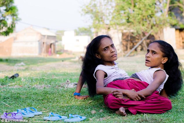 Indian conjoined twins, 45, finally find love - PHOTO+VIDEO