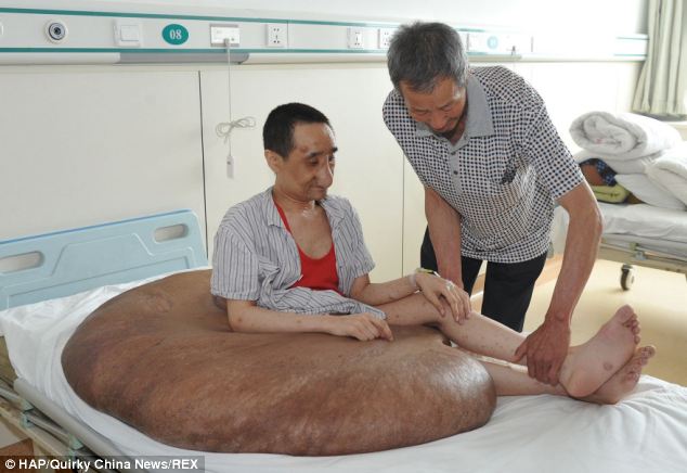 Man has world's 'largest tumour' removed from his leg - PHOTO