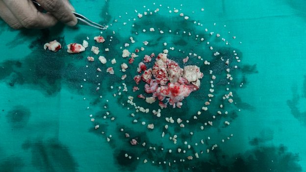 Doctors remove 232 teeth from boy's mouth - PHOTO