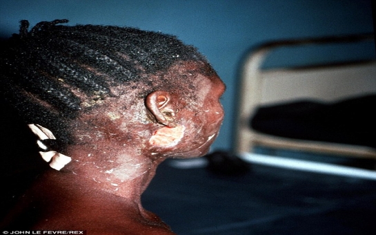 What happens when you are infected with the Ebola virus? - PHOTO