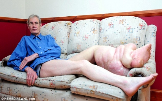 Pensioner dubbed the Elephant Man because of two-stone leg - PHOTO