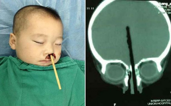 Boy has CHOPSTICK removed from brain after shoving it up his nose - PHOTO