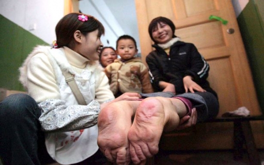 Miracle woman born with backwards feet - PHOTO