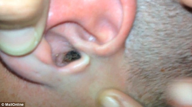 LIVE inch-long moth and a tick are pulled out from a man's ear - PHOTO+VIDEO