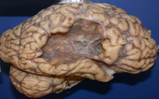 Brain of a stroke survivor