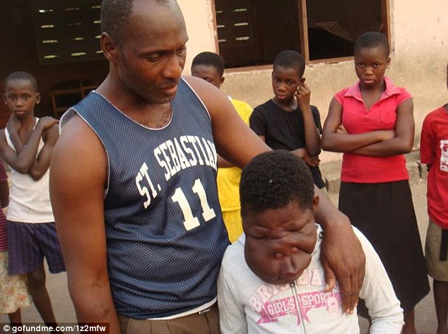 Orphaned girl, 13, with a severe facial deformity - PHOTO