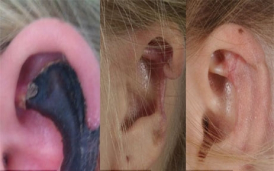Woman's ear turns black spider bite