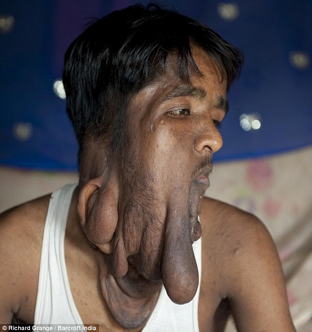 Indian man with huge facial tumour undergoes surgery - PHOTO+VIDEO