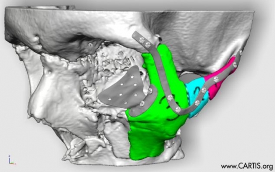 Surgeons will reconstruct road accident victim's face using 3D printing