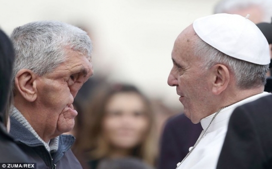 Pope Francis blesses severely disfigured man without a face -