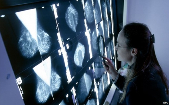 Cholesterol 'fuels' breast cancer