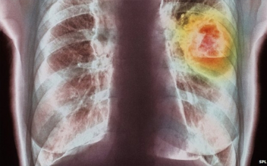 Global cancer cases reach 14 million, WHO says