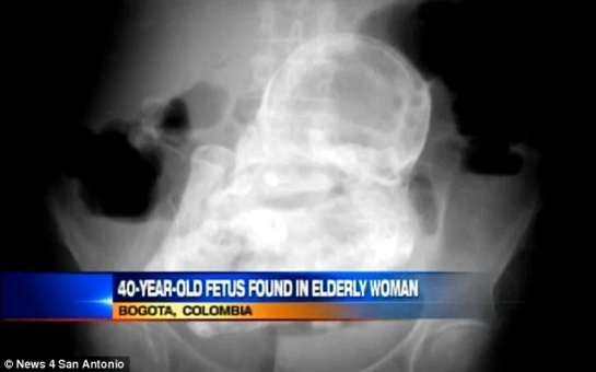 Woman with stomach pain is found to have a 40-year-old fetus inside her