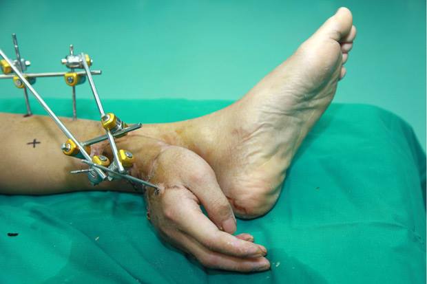 Man has severed hand successfully reattached after... - PHOTO