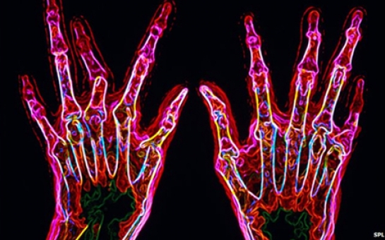 New genetic clues for arthritis