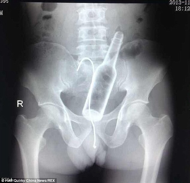 Eye-watering X-rays show bottle stuck in man rear - PHOTO