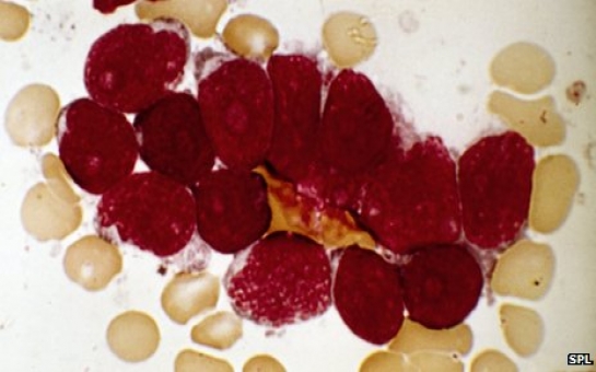 Antibody machinery can misfire and cause leukaemia