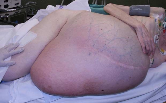 Woman has SIX STONE tumour removed from her stomach - PHOTO