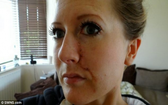 Tanning addict left with massive tumour on her face