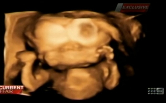 Our unborn baby has two brains and two faces - PHOTO+VIDEO