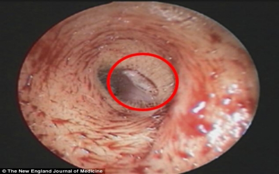 Woman discovers she has a MAGGOT living in her ear