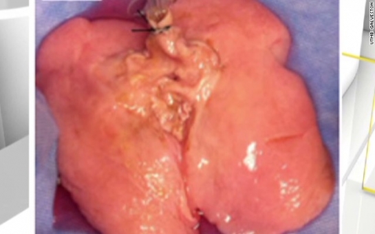 Human lung made in lab for first time