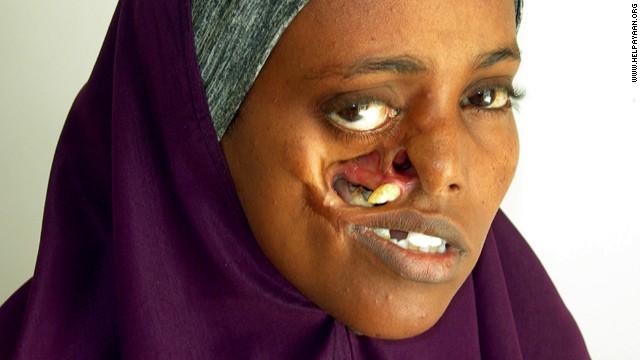 Woman waits 23 years for surgery to fix shattered face - PHOTO