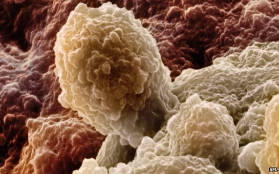 DNA prostate test 'will predict deadliest cancer risk'