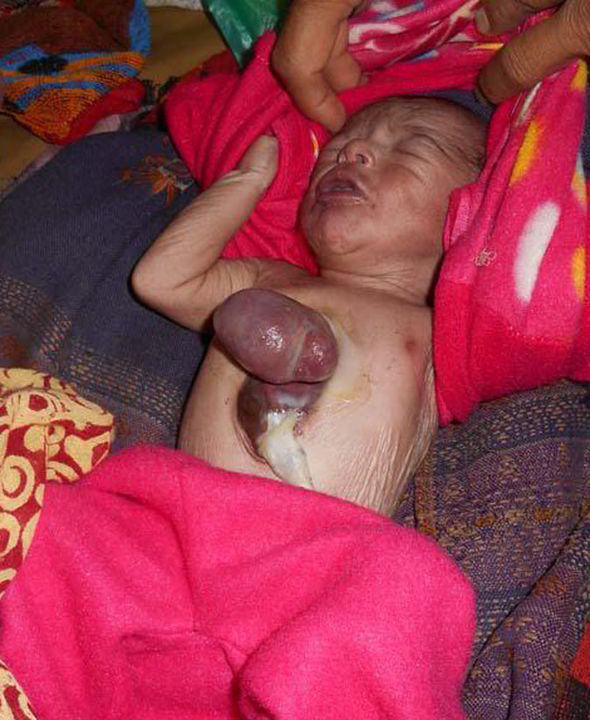 Baby is born with his heart on the outside of his body - PHOTO+VIDEO