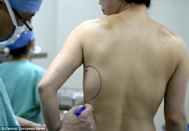 Woman whose implants moved to her BACK and STOMACH - PHOTO