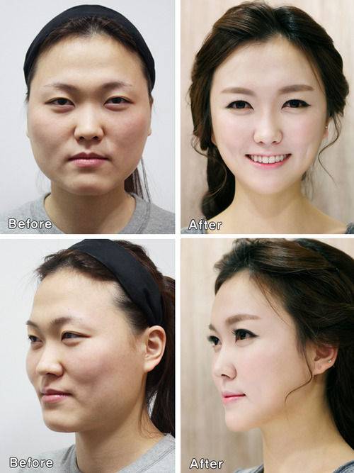 Plastic surgery in South Korea is so good - PHOTO