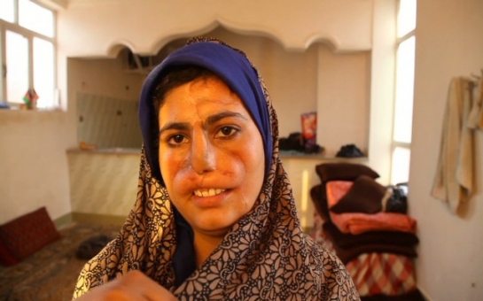 Afghan wife maimed for refusing drug-addict husband's cash demands