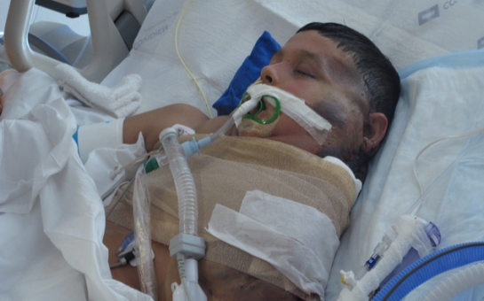 Mexican boy is recovering after watermelon-sized tumor is removed - VIDEO