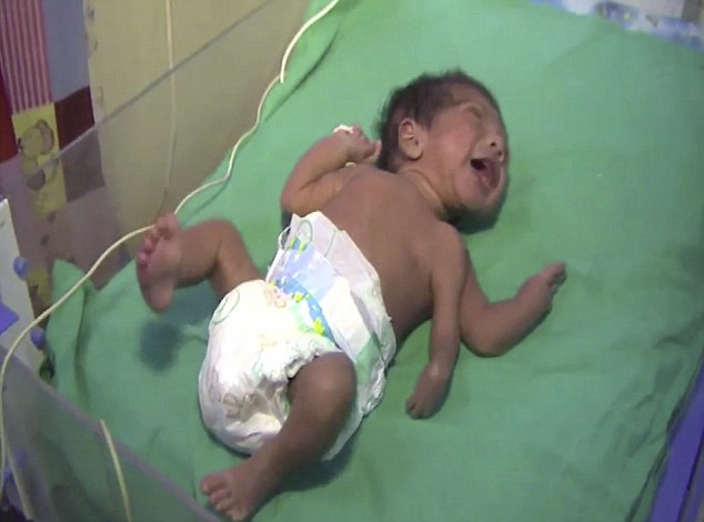Baby born with THREE arms