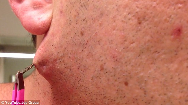Man pulls the world's longest ingrown HAIR out of his face goes viral