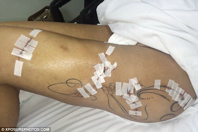 Miss BumBum contestant reveals the shocking damage caused by fillers injected