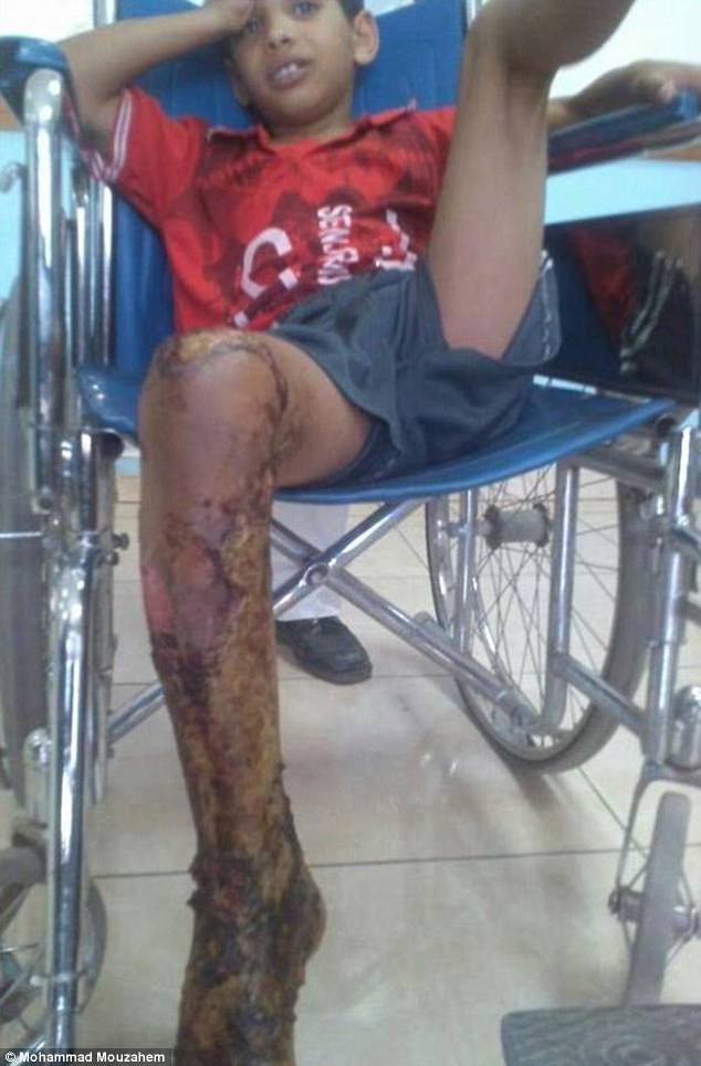 Yemeni boy, 10, locked in a cage and set alight by his friends