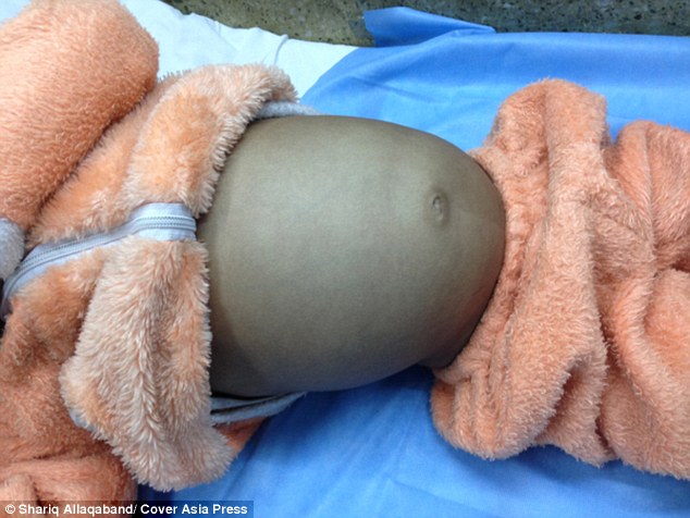 Boy, 4, has huge 4ft hairball removed by doctors