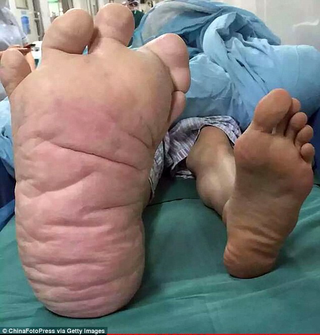 The man whose foot swelled to an astonishing size TWENTY-NINE