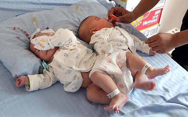 Doctors separate conjoined twins with help of 3D printer