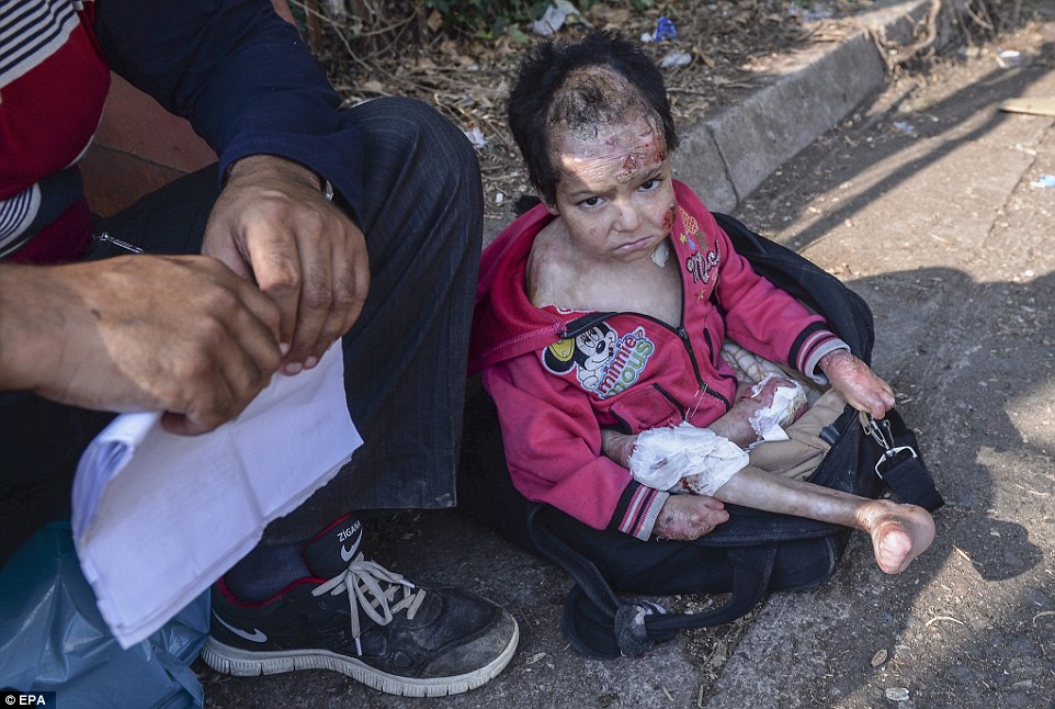 Parents flee Syria with their badly burned little girl