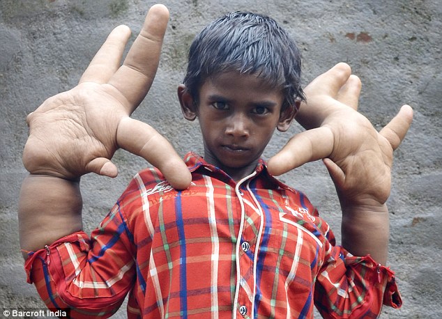 Hope for the boy with the world's biggest hands